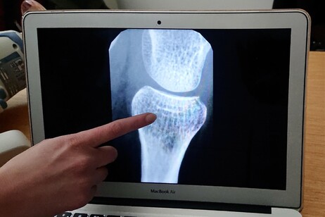 Miles de italianas afectadas por la osteoporosis