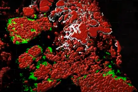 Un esempio di mappa 3D di un tumore (fonte: WashU Medicine da YouTube)