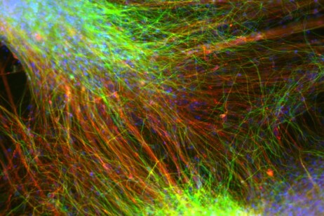 Neuronas diferenciadas células madre implantadas en pacientes Parkinson. (Fuente Malin Parmar Lab)