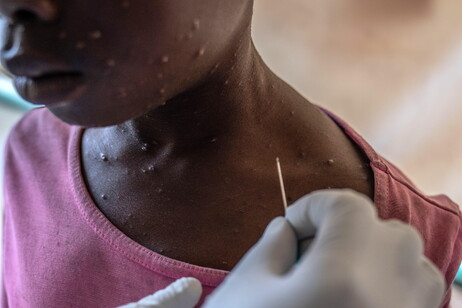 África precisa de 10 milhões de doses de vacina para conter mpox