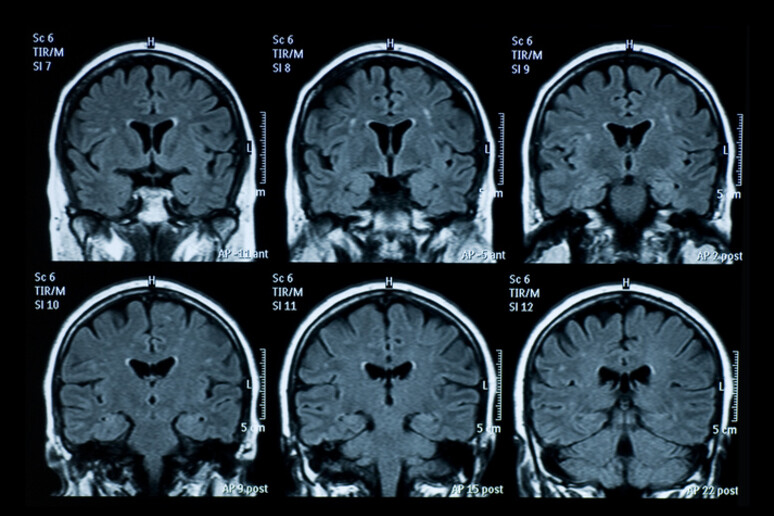 L 'ipotesi di un virus per alcuni casi di Alzheimer - RIPRODUZIONE RISERVATA